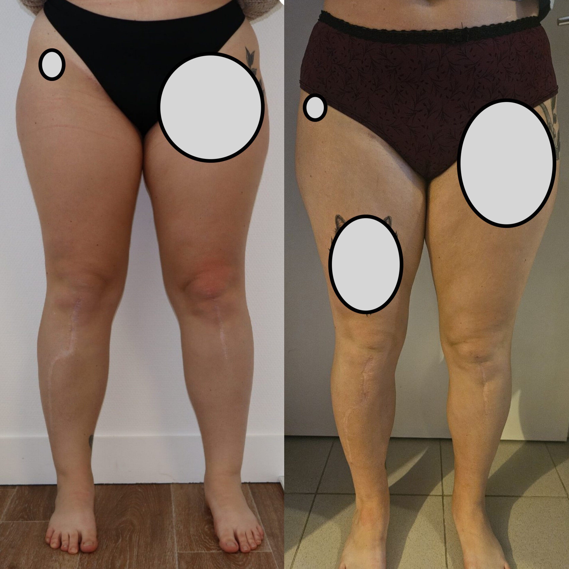 Avant/Après lipoaspiration lipoedeme